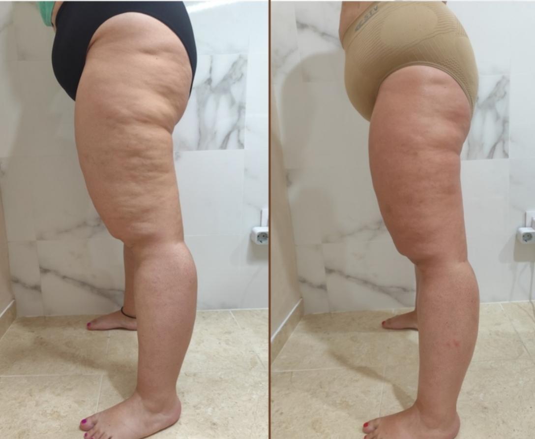 Imagen Antes y Después