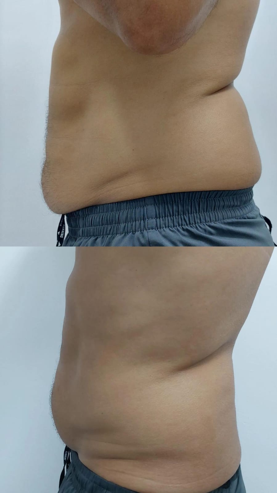 Imagen Antes y Después