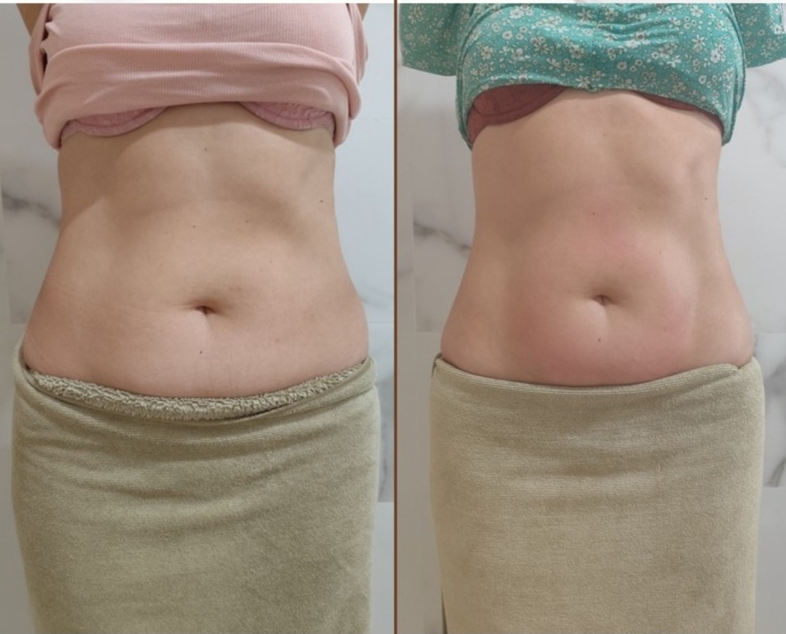 Imagen Antes y Después