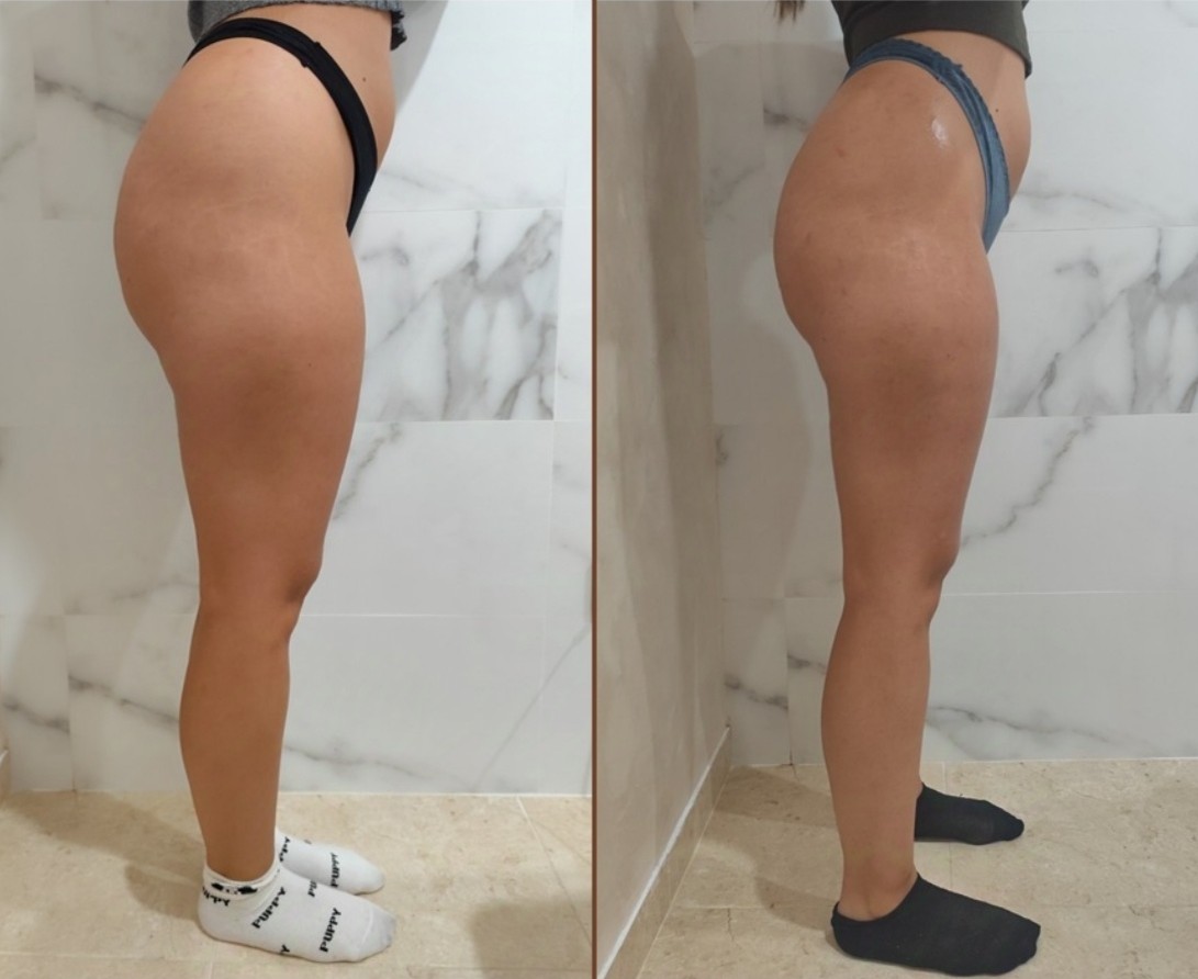 Imagen Antes y Después