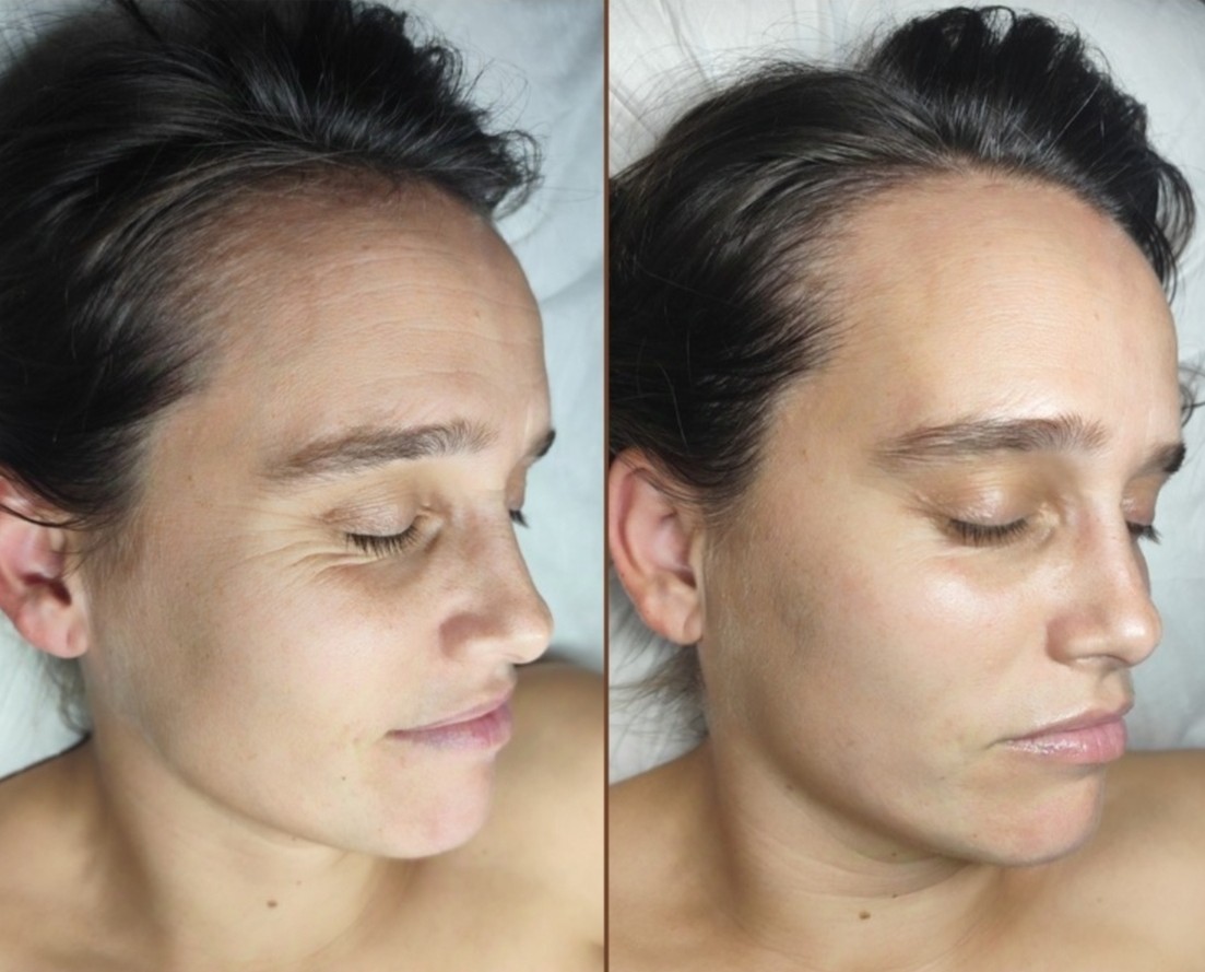 Imagen Antes y Después