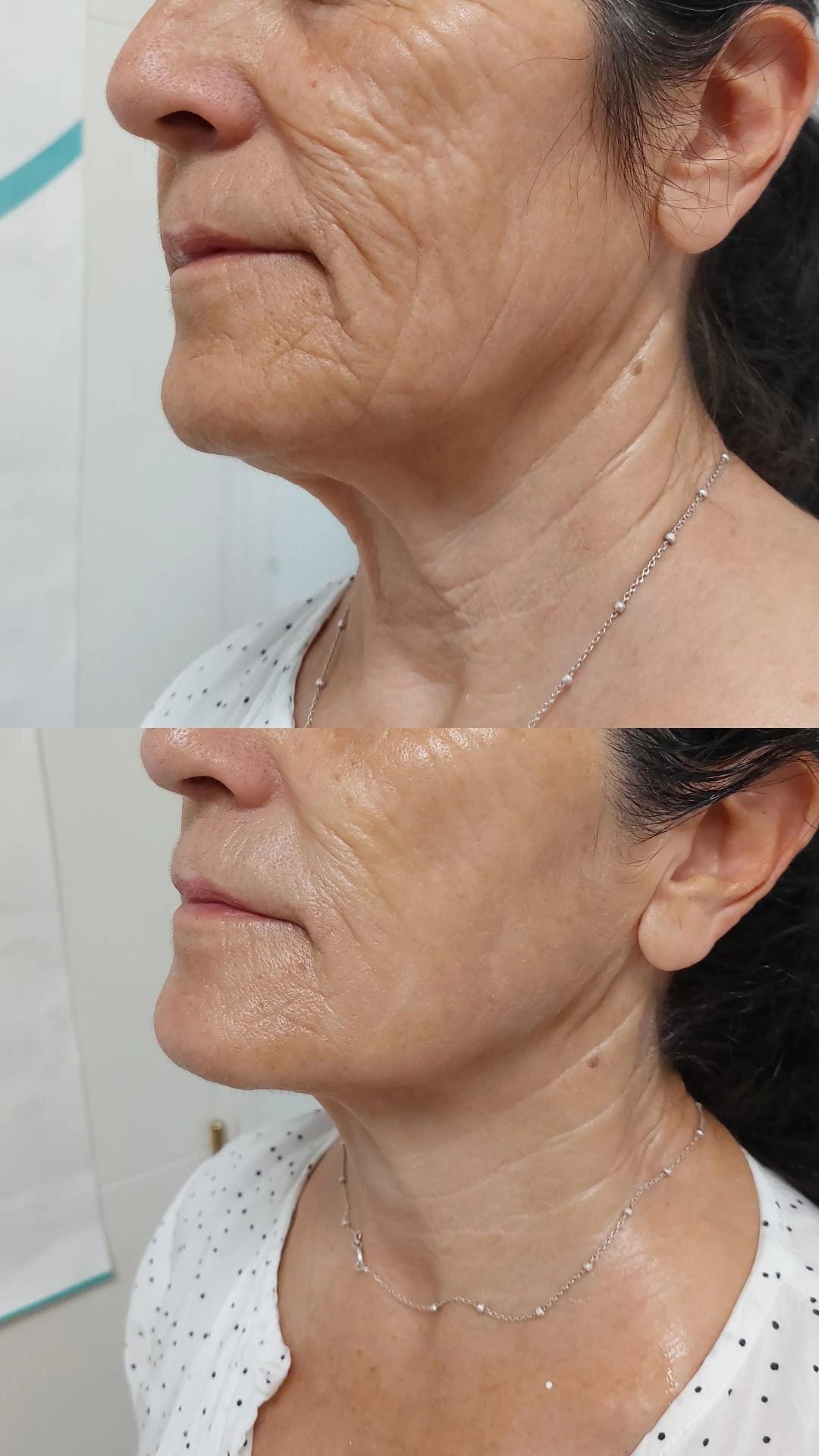 Imagen Antes y Después