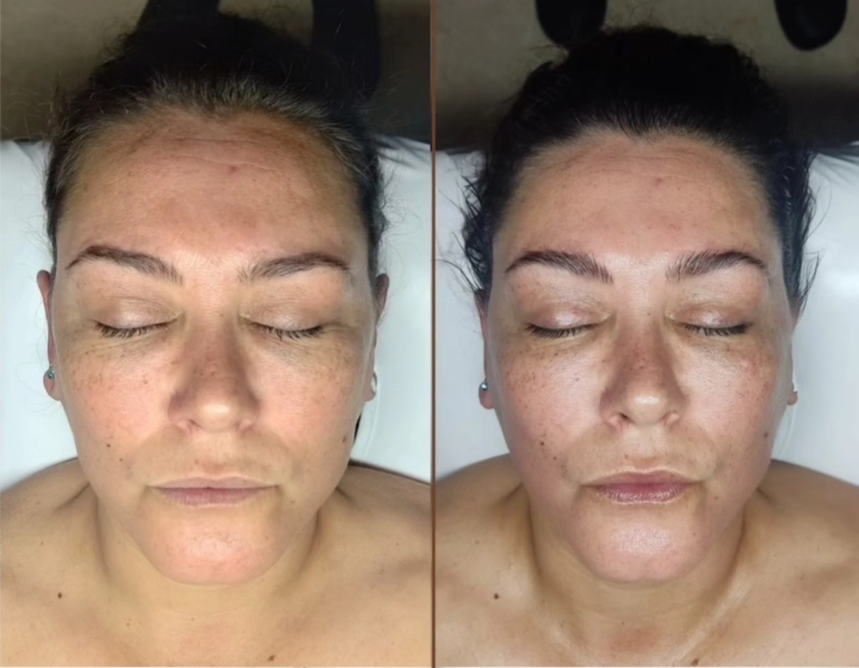 Imagen Antes y Después