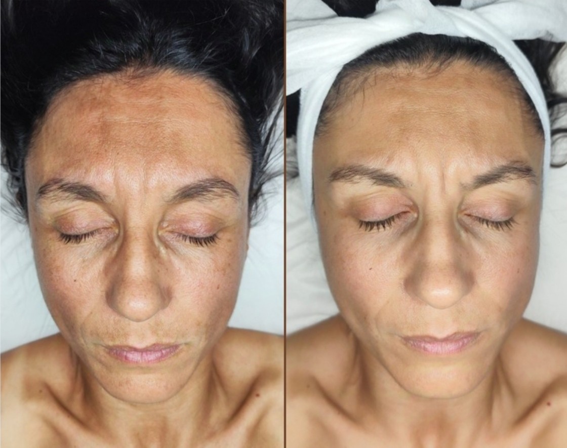 Imagen Antes y Después