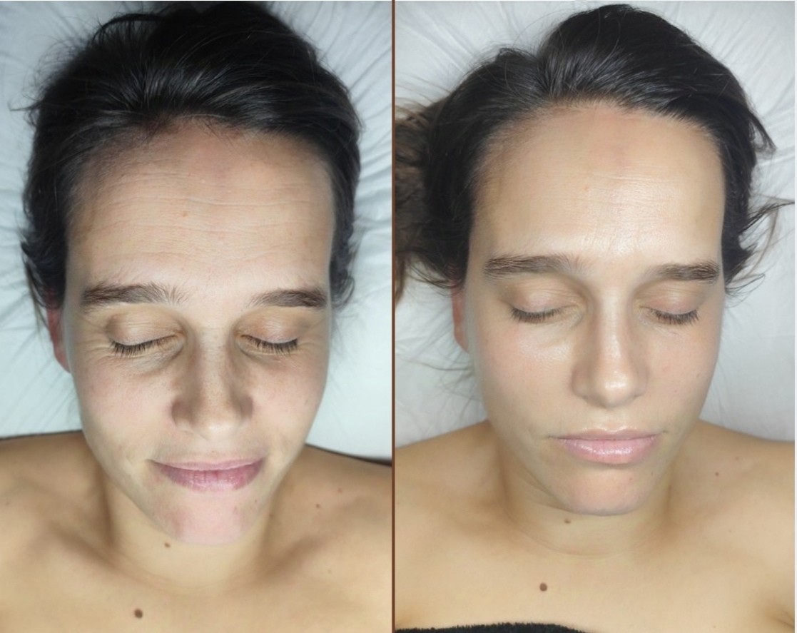 Imagen Antes y Después