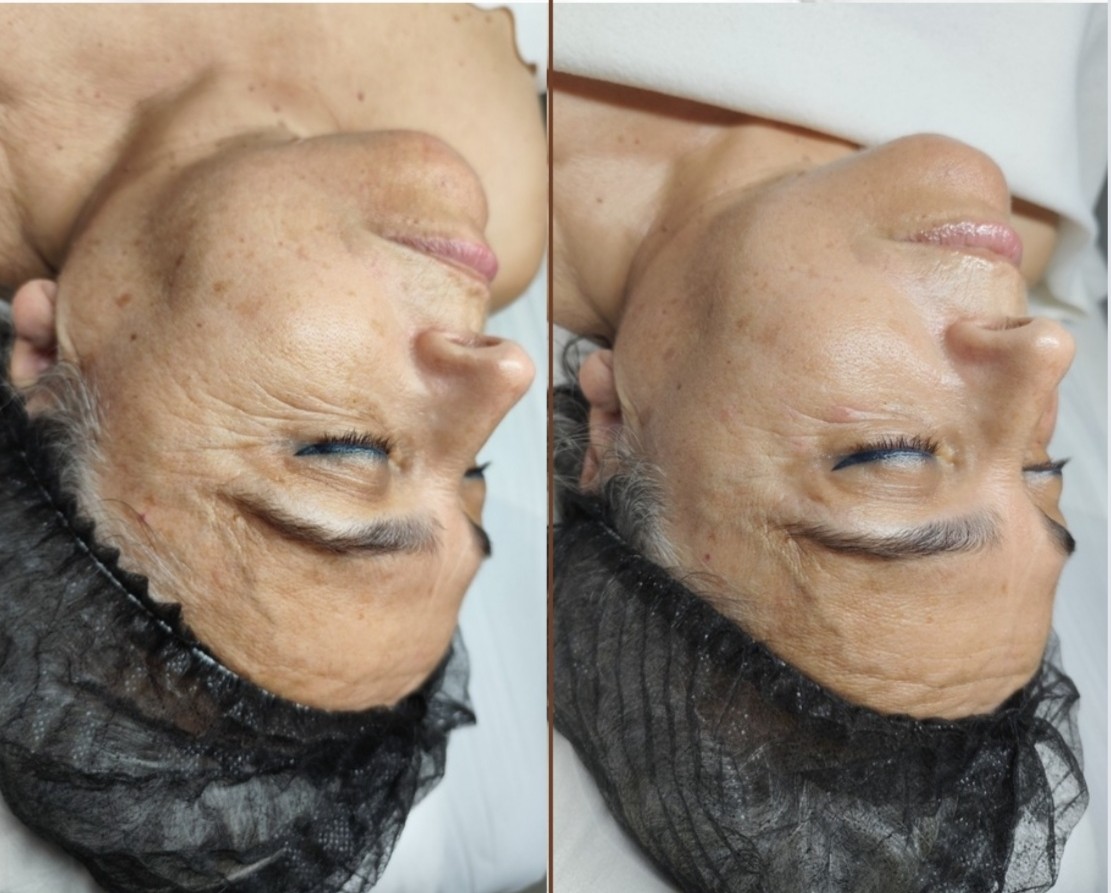 Imagen Antes y Después